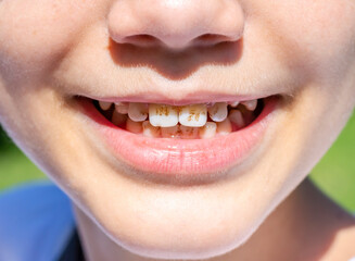 Dark plaque on children's teeth. Priestley's raid. Dental health concept. Oral care. Pediatric...