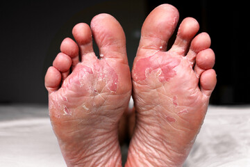 Close up of dry feet. Peeling and cracked foot. Fungal infection or athlete's foot, dry skin,...