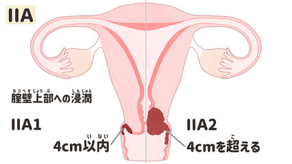 Obraz premium Cervical cancer stage 2A diagram PNG