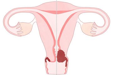 Blank cervical cancer stage 2A diagram PNG