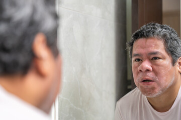 Man with vitiligo skin condition looking on the mirror