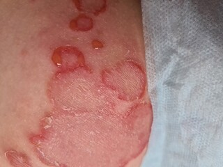 Close Up of Annular Eruption on Skin
