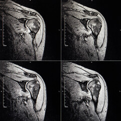 MRI image of the shoulder joint after dislocation. Impression fracture of the humeral head....
