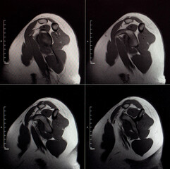MRI image of the shoulder joint after a fracture and dislocation. Impression fracture of the...