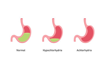 Hypochlorhydria and Achlorhydria Scientific Design. Vector Illustration.