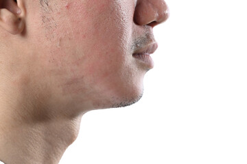 Obraz premium Man undergoing CO2 laser resurfacing for facial rejuvenation isolate on white background