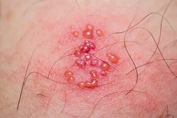 skin rash and blisters on body
(Shingles,herpes zoster)