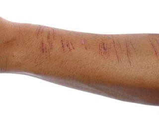 Graphic close up of a man arm showcasing multiple fresh cuts and bruises, detailed photo of a male forearm revealing visible signs of recent physical trauma