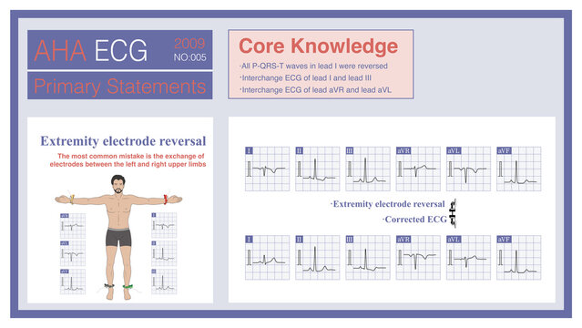 When the limb leads are reversed, it is common for the left upper limb and the right upper limb to be reversed, affecting the ECG pattern of the limb leads.