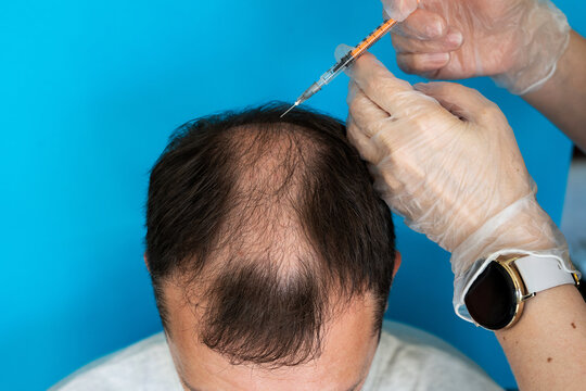 Prp For Hair Images – Browse 2,218 Stock Photos, Vectors, and Video | Adobe Stock