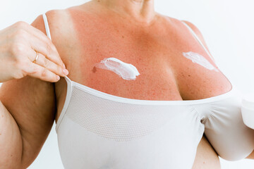 sunburn on woman's body is lubricated with moisturizer