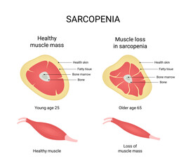 Vector illustration of healthy muscle mass and muscle loss in sarcopenia