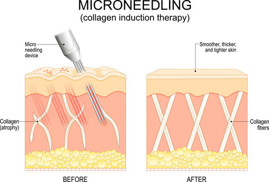 Microneedling procedure. Skin rejuvenation
