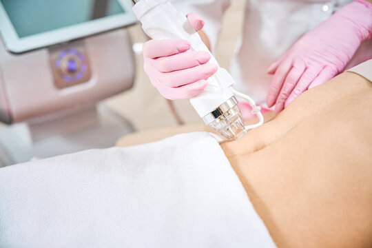 Cosmetologist conducting RF microneedling on female client body