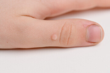 Wart on finger. Close-up of wart on child hand. Common wart Verruca vulgaris is caused by type of human papillomavirus, HPV.