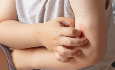 Allergic reaction on the skin. childhood allergies, insect bites, food allergies. bloody spots on...