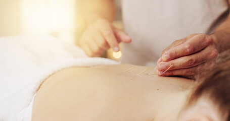 Acupuncture, hands and stress relief in spa with customer for healing, holistic therapy or to...