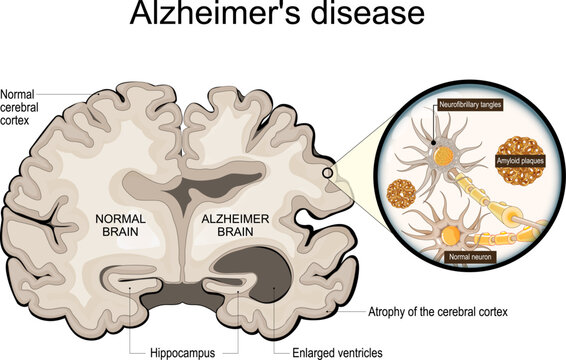 Alzheimer disease. Hippocampus. Close-up of neurons with Neurofibrillary tangles and Amyloid plaques