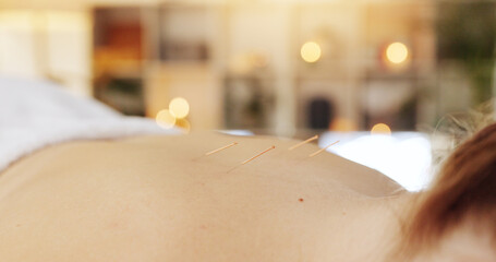 Acupuncture, needles and skin for wellness in spa, alternative medicine or healing therapy. Relax,...