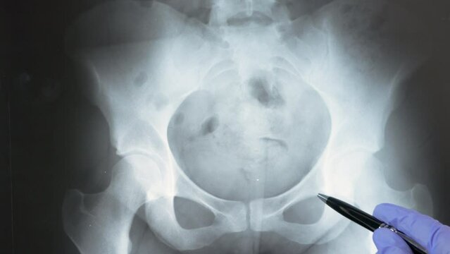 Doctor radiologically analyzing the pelvic bone with x-ray.
Hand of a doctor analyzing and pointing with a pen to the affected area.
