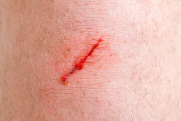 Young adult man red abrasion knee skin bleeding after fell down. Closeup. Front view.