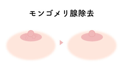 モンゴメリ腺