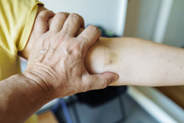 man's hand tightly grabbed woman's hand, bruises from pressure and violence