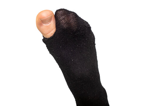 Der gro&szlig;e Zeh ging durch die Socke, weil die Socke gerissen war und ein Loch darin hatte
