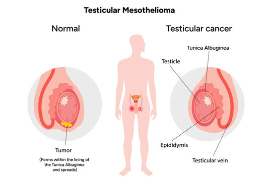 Mesothelioma disease, Testicular mesothelioma