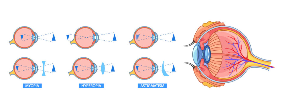 Detailed Eye Anatomy Infographic Explaining Myopia, Hyperopia, And Astigmatism. Visual Representation Of Eye Structure
