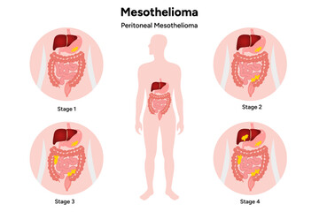 Mesothelioma disease, Pericardial mesothelioma, 4 stages