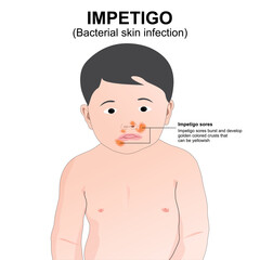 Impetigo on kids illustration of bacterial skin infection