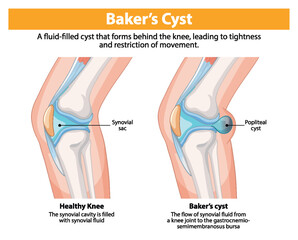 Comparison of healthy knee and Baker's cyst