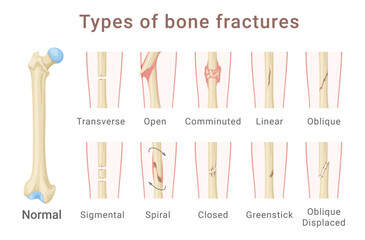 Types of femoral shaft bone fracture medical scheme infographic isometric vector illustration