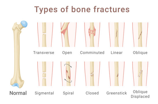 Types of femoral shaft bone fracture medical scheme infographic isometric vector illustration