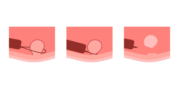 Stage removal polyp in colon, colonoscopy intestine, polypectomy procedure. Checkup gut, colon surgery. Operation intestine. Vector flat illustration