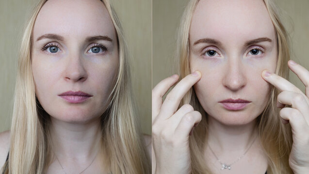 Before and after eye drops to examine the fundus, pupil dilation. A doctor performs an ophthalmoscopy on a woman who has mydriasis and accommodation spasm. Poor vision and paralysis of the eye muscles