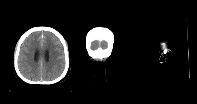 A CT scan of the brain shows a subarachnoid hemorrhage scattered at both frontal lobes, temporal lobes, basal cistern and prepontine cistern., highlighting areas of bleeding.