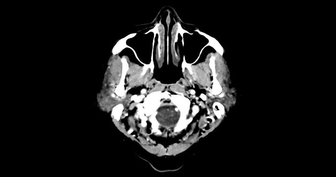 A CT scan of the brain shows a subarachnoid hemorrhage scattered at both frontal lobes, temporal lobes, basal cistern and prepontine cistern., highlighting areas of bleeding.