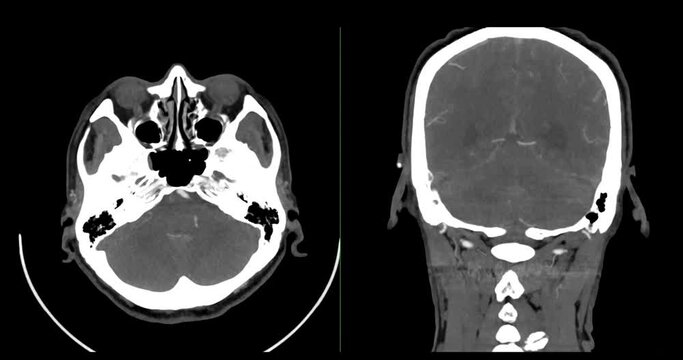 A CT scan of the brain shows a subarachnoid hemorrhage scattered at both frontal lobes, temporal lobes, basal cistern and prepontine cistern., highlighting areas of bleeding.