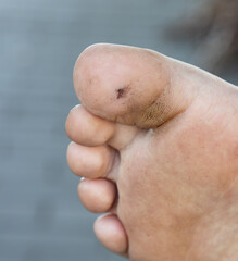 small wound on toe as background.