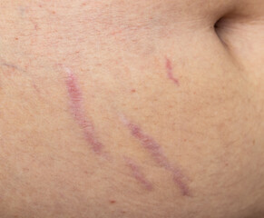 scars from stretch marks on the skin of the abdomen.