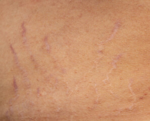 scars from stretch marks on the skin of the abdomen.
