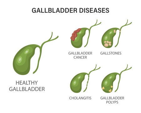Gallbladder diseases infographics. Gallstone disease, cancer, acute cholecystitis, cholangitis or polyps of the digestive system. Problems with the biliary tract. Illustration.