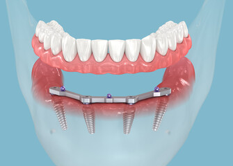 Dental prosthesis based on All on 4 system supported by implants. 3D illustration of human teeth and dentures concept