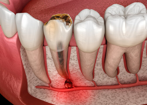 Periostitis tooth - Lump on Gum Above Tooth. Dental 3D illustration