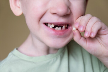 Child shows baby teeth. Caring for childrens teeth, dental medicine concept. Closeup