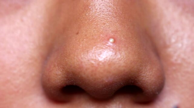 the tip of the brown skin nose with pimple and bla