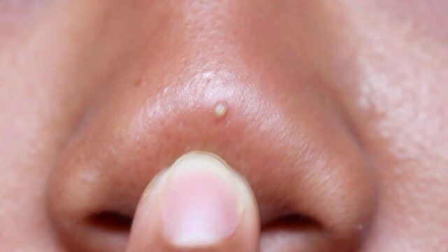 asian girl finger press nose with acne. 