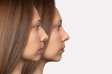Collage before and after plastic surgery on the nose, isolated on a white background. Woman's face in profile. Correction of the nasal septum, rhinoplasty, septoplasty. Straightening the hump